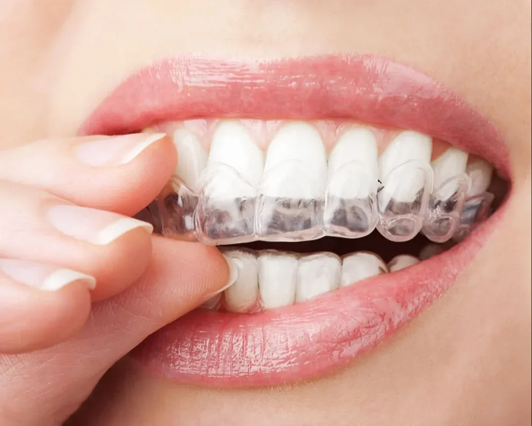 Close-up of a person fitting a transparent clear aligner tray over their upper teeth